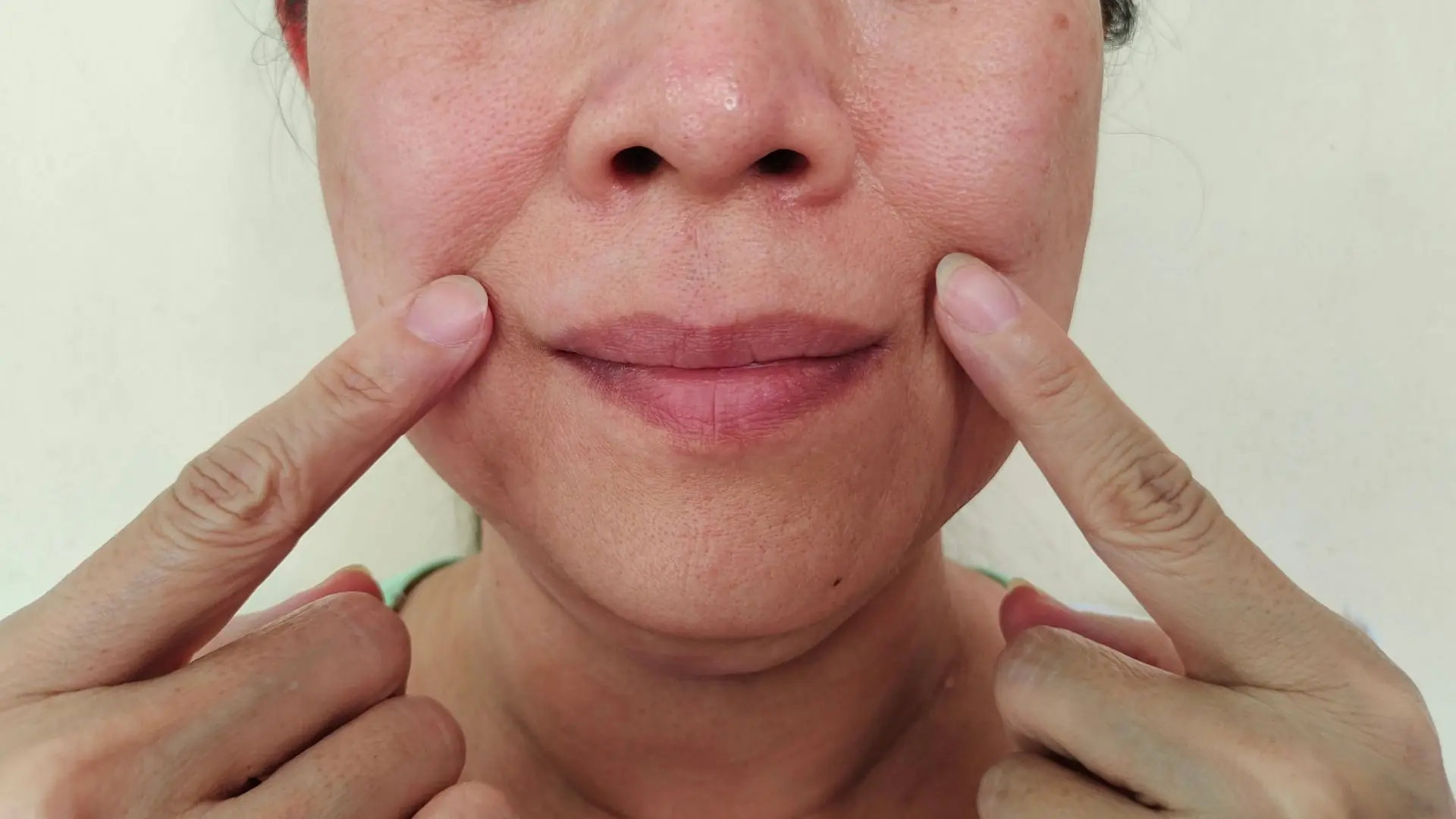 Căng Da Rãnh Cười Thermage FLX Có Làm Cứng Biểu Cảm Không