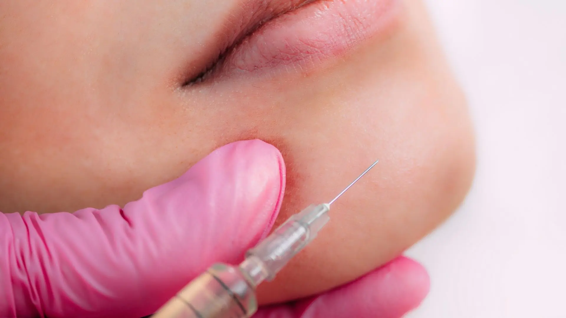 Giá Tiêm Filler Cằm Bao Nhiêu ở Bệnh Viện HCM