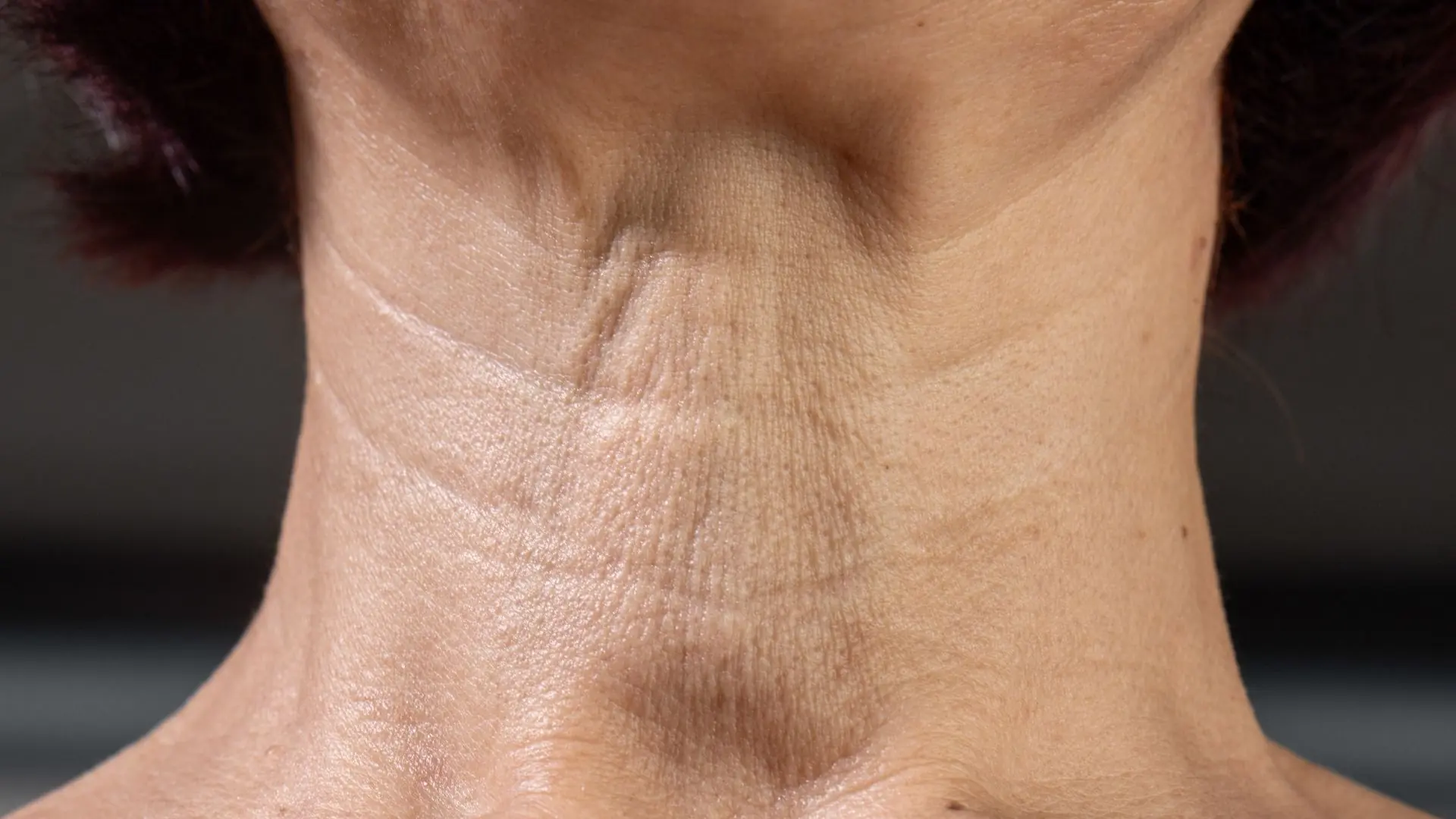 Mất Elastin ảnh Hưởng đến độ Săn Chắc Vùng Cổ Ra Sao