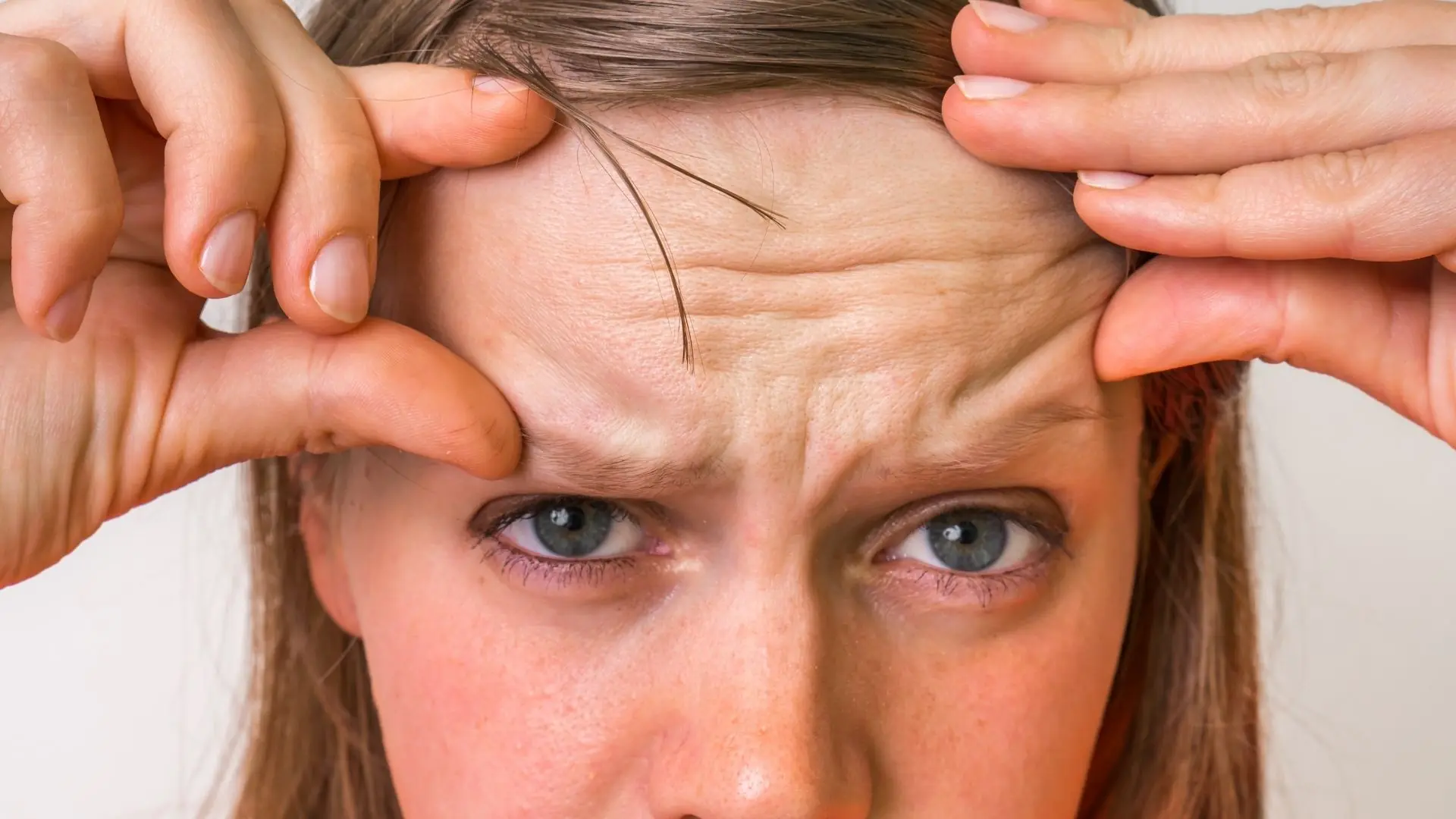 Nếp Nhăn Trán Có Liên Quan đến Yếu Tố Di Truyền Không