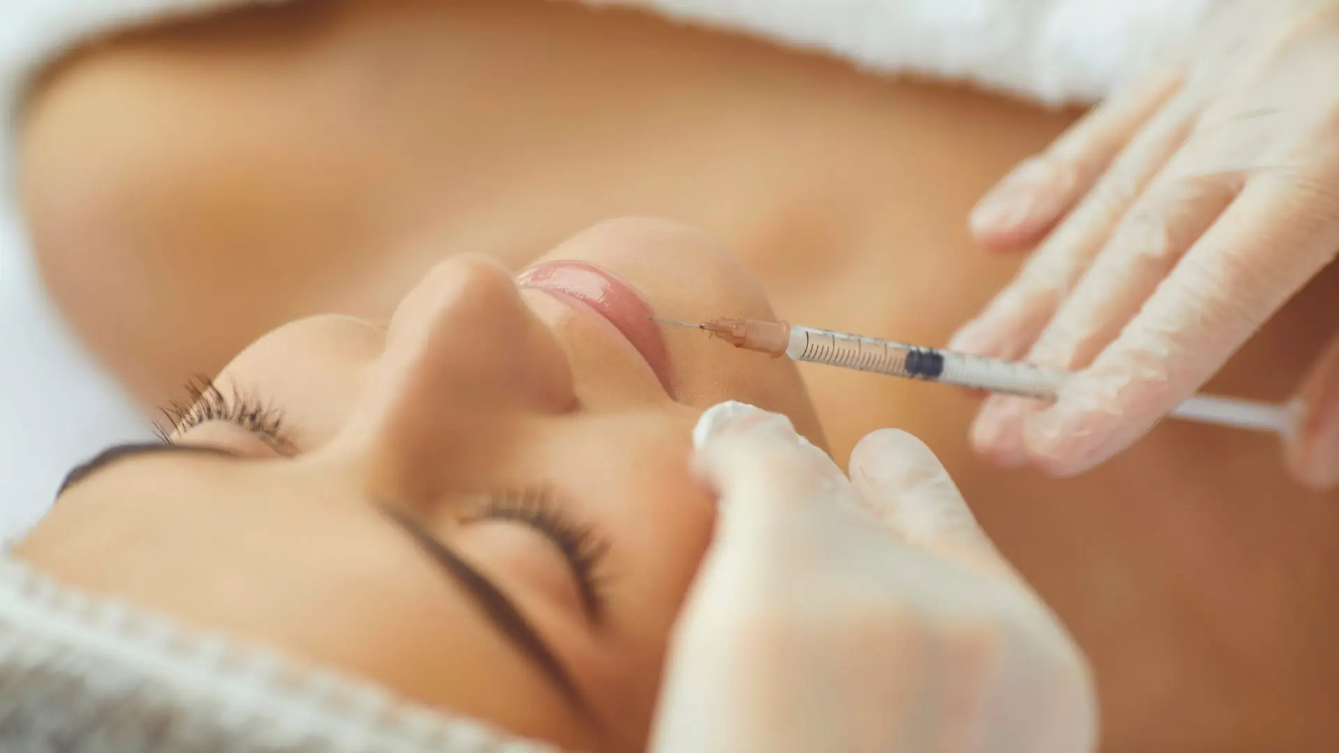 Tiêm Filler Rãnh Cười Là Gì Có Bao Nhiêu Loại Filler Cho Rãnh Cười