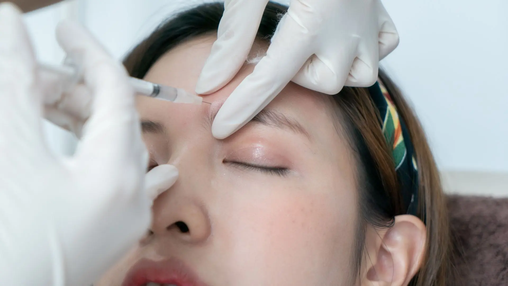 Tiêm Filler Vùng Trán Là Gì Có Bao Nhiêu Loại Filler Cho Trán