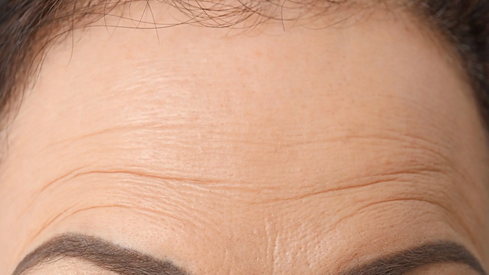 Ultherapy Prime Nâng Cơ, Trẻ Hóa Vùng Trán Có đáng Lựa Chọn
