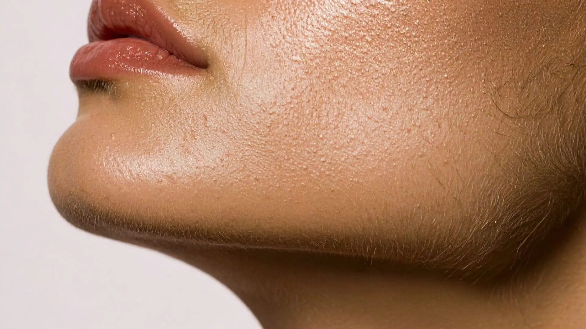 Ultherapy Prime Nâng Cơ, Trẻ Hóa Vùng Viền Hàm Có Phù Hợp